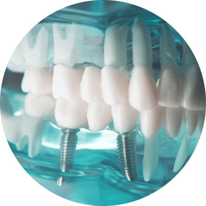 dental implant model